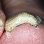 درمان ناخن ضخیم شده پا