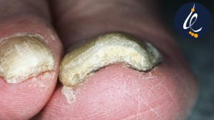 درمان ناخن ضخیم شده پا