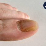 درمان ناخن قارچ زده