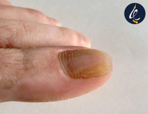 درمان ناخن قارچ زده