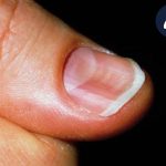 درمان ناخن قاشقی