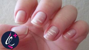 لکونیشیا، خطوط یا لکه های سفید روی ناخن