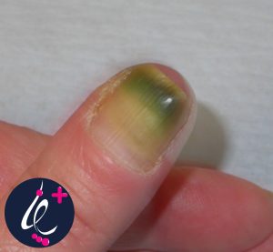 علت سبز شدن ناخن