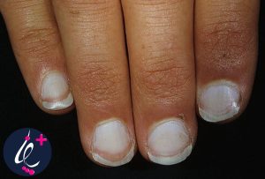 علل بیرنگ شدن ناخن ها و بیماری های مرتبط