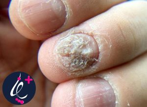 ناخن پوسته شده چیست؟