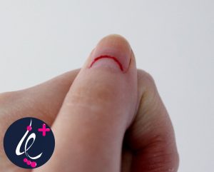 ناخن ضربه‌خورده
