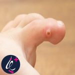زگیل پا چیست و چرا ایجاد میشود؟