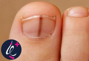 درمان ملانوم ناخن