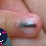 ملانوم یا سرطان ناخن چیست؟