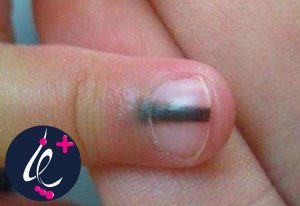 ملانوم (سرطان) ناخن چیست؟