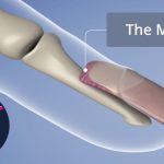 ماتریکس ناخن چیست؟