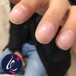 ناخن چماقی یا برآمده