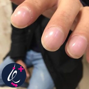 ناخن چماقی یا برآمده