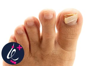 جدا شدن و افتادن ناخن یا اونیکوپتوز