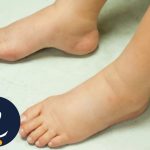 ورم پا در افراد دیابتی