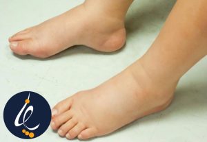 ورم پا در افراد دیابتی