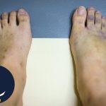 کبودی پای دیابتی