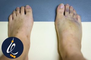 کبودی پای دیابتی