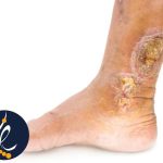زخم مچ پای دیابتی
