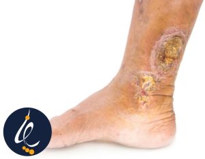 زخم مچ پای دیابتی