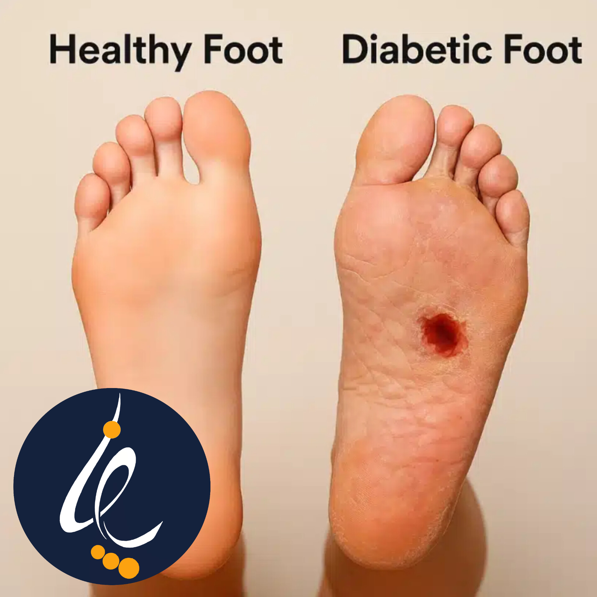 انواع زخم دیابتی