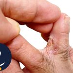 زخم لای انگشت دیابتی