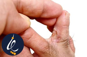 زخم لای انگشت دیابتی