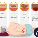 مراحل زخم بستر (زخم بستر درجه ۱ تا ۴)