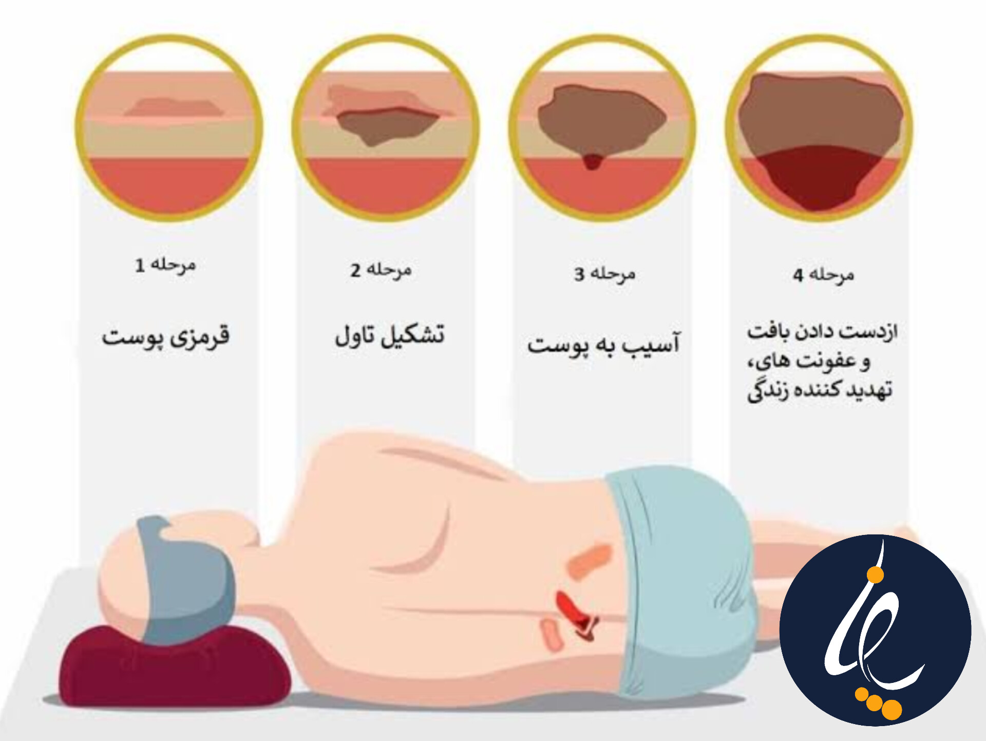 مراحل زخم بستر (زخم بستر درجه ۱ تا ۴)